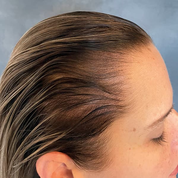 Nachher – Scalp Micropigmentation Vorher-Nachher: zurückgewichene Geheimratsecken und Stirnhaaransatz natürlich aufgefüllt