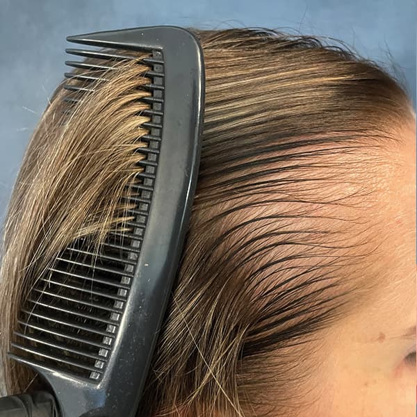Vorher – Scalp Micropigmentation Vorher-Nachher: zurückgewichene Geheimratsecken und Stirnhaaransatz natürlich aufgefüllt