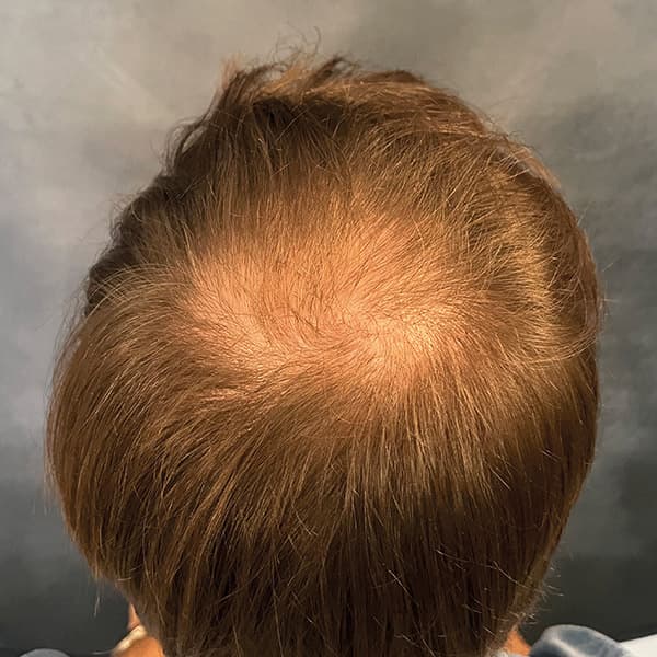 Vorher – Scalp Micropigmentation Vorher-Nachher: lichter Oberkopf durch Haarpigmentierung sichtbar verdichtet