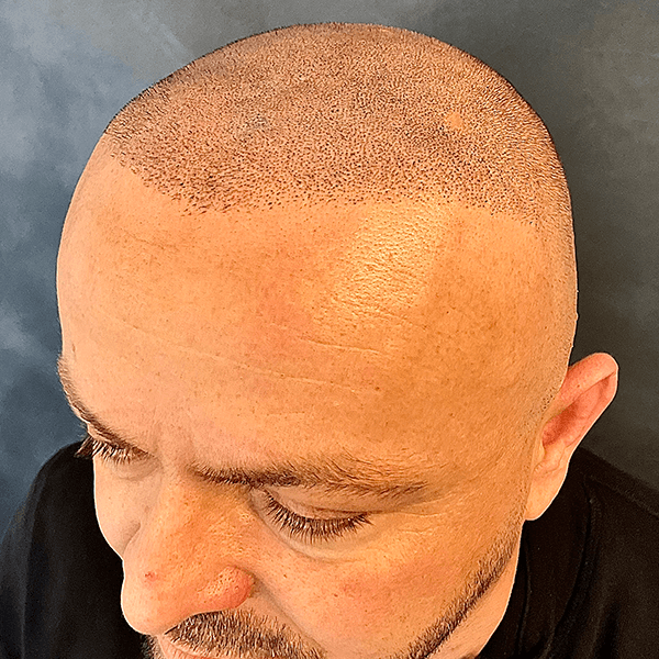Nachher – Scalp Micropigmentation Shavelook Vorher-Nachher: klarer, natürlich wirkender Haaransatz am rasierten Kopf