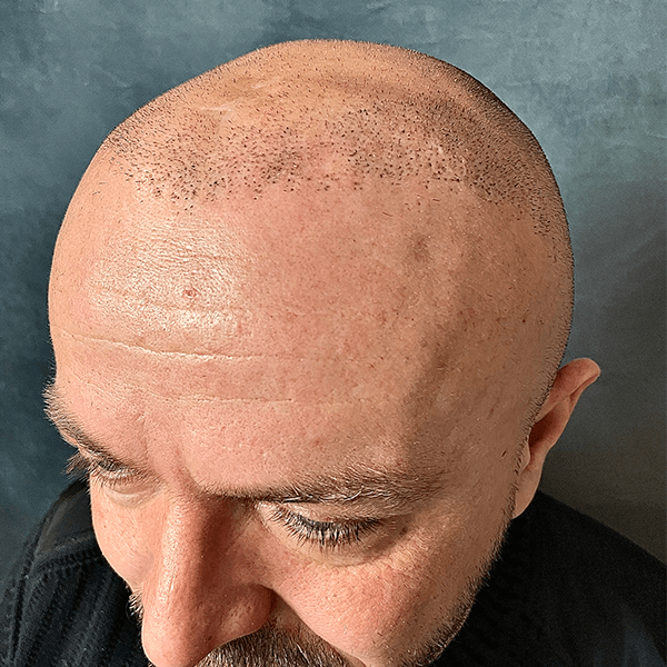 Vorher – Scalp Micropigmentation Shavelook Vorher-Nachher: klarer, natürlich wirkender Haaransatz am rasierten Kopf